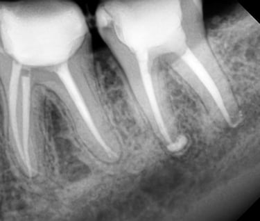 Best root canal treatment done at top dental clinic near Chincholi Malad west in Mumbai