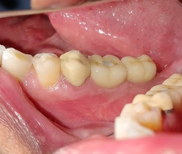 missing teeth replaced with dental implants by best implantologist in malad west mumbai