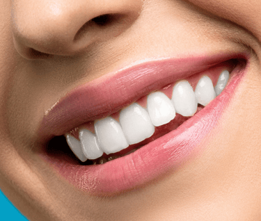 White straight teeth after teeth whitening at best dental clinic in Orlem Malad west Mumbai