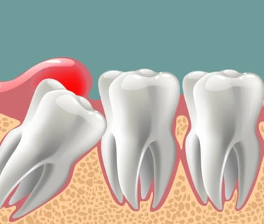wisdom tooth stuck & paining and needs removal by Oral Surgeon in Malad