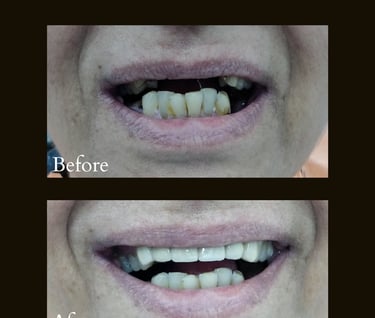Ceramic Caps with dental implants used for replacing missing front teeth giving beautiful smile