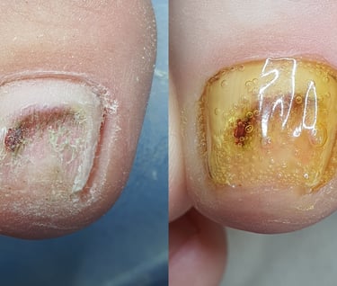 traumuotas nagas protezavimas