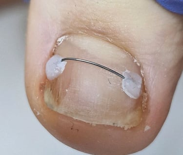 nago korekcija titano siulas