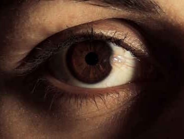 pterygium