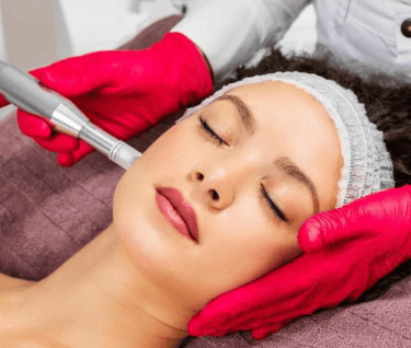 Professional facial microneedling treatment for skin rejuvenation and anti-aging therapy.