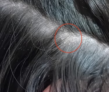 Image d'un cuir chevelu souffrant de sécheresse, entourée en rouge