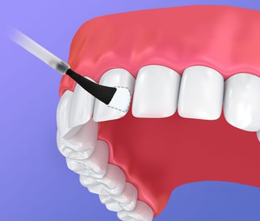 Fluoride Application