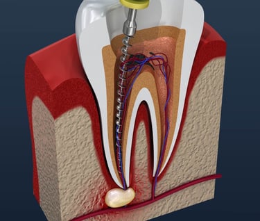 A photo of Root Canal Treatment