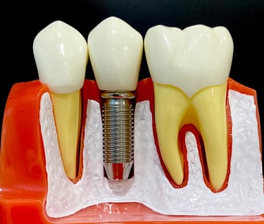 Dental Implants