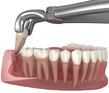 A photo of wisdom tooth removal