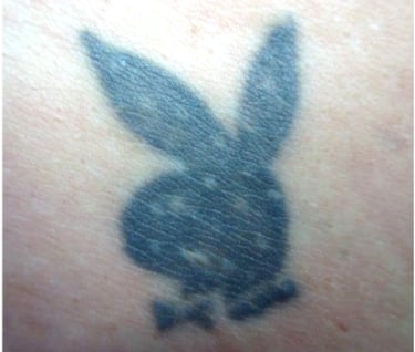 electrolysis-and-tattoos