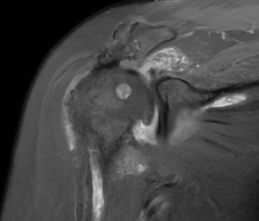 Hombro con lesión masiva de mango rotador por resonancia magnética.