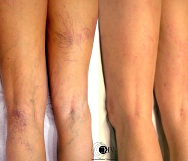 Tratamiento Varices, Antes y después, Cambrils, Tarragona, Instituto Médico Vilafortuny,