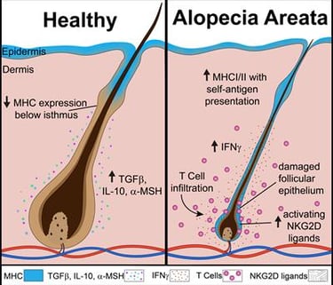 alopecia areata