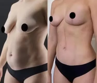 breast reduction before after photos