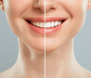 Best Teeth Whitening Treatment Clinic in Vashi, Navi Mumbai | Ekdantam dental clinic