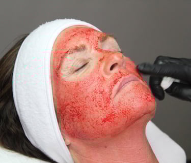 Ansigt under en Vampire Facial vampyr behandling