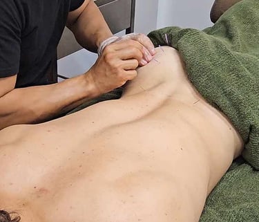 Dry Needling Male Glutes at Advance Body Massage Wollongong