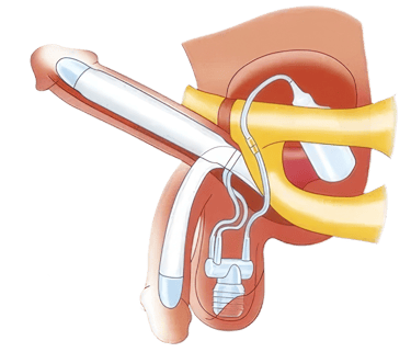 دعامة العضو الذكرى