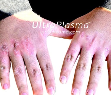 ultraplasma.com ultra plasma ultra plazma psoriasis sedef treatment tedavi