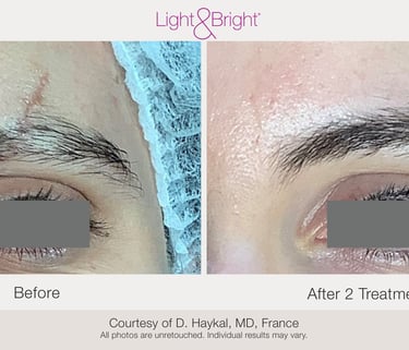 acne scar treatment for body skin improvement in Hamilton Ontario