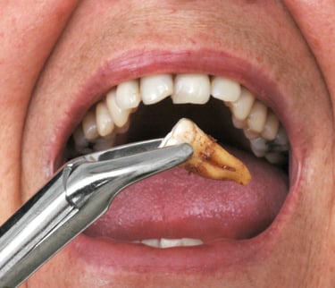 زراعة الأسنان - عيادة طب الاسنان دكتور وسام علي العباسي