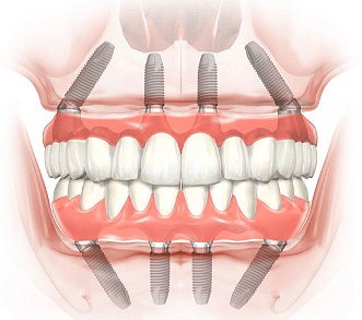 All-on-4 procedure