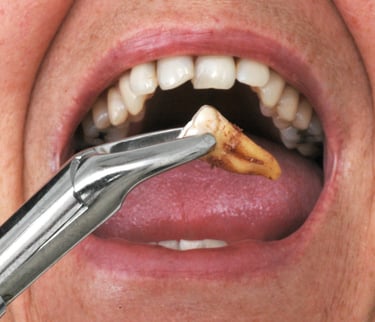 زراعة الأسنان - عيادة طب الاسنان دكتور وسام علي العباسي