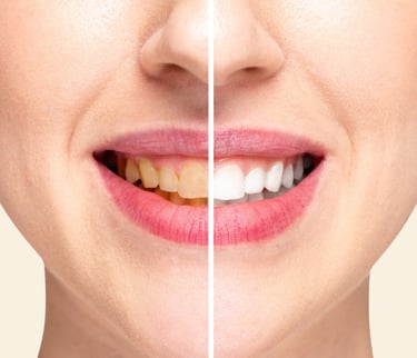 زراعة الأسنان - عيادة طب الاسنان دكتور وسام علي العباسي