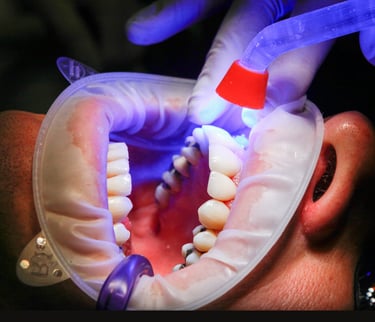 زراعة الأسنان - عيادة طب الاسنان دكتور وسام علي العباسي