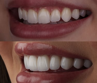 Before and after dental porcelain veneers showing a smile transformation with bright white teeth.