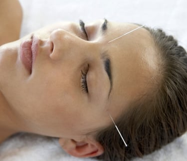 Close‑up of a person receiving acupuncture with fine needles placed on the forehead and temple