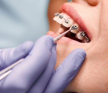 Orthodontist in purple gloves adjusting metal dental braces on a patient's teeth with a medical tool.