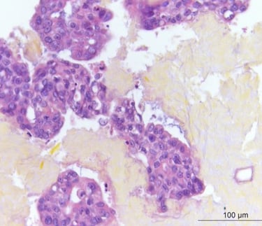 Human cancer cells forming tumors from cells produced at CTIBIOTECH