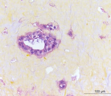 Human cancer tumor showing an area with hypoxia in the center. CTIBIOTECH