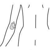 Diagram of Painmaster patches on the back of the elbow.