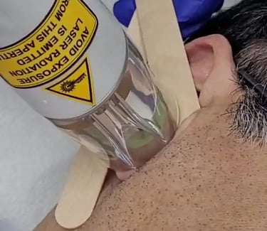 Ear hair removal laser at Ariana Esthetic Edmonton