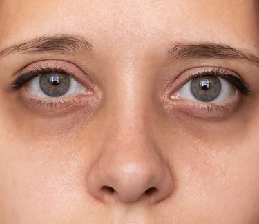 Expert dark circle treatment and glow treatment available in Vadodara. Visit best skin specialist & dermatologist in Vadodara