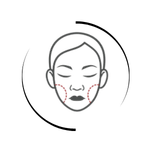 Facial illustration showing targeted cheek areas for bichectomy