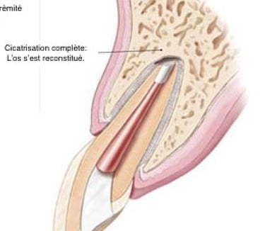 Chirurgie endodontique