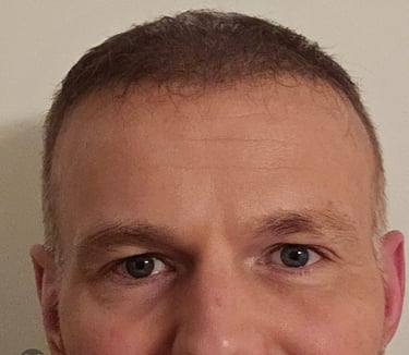 a man after his anti wrinkle treatment