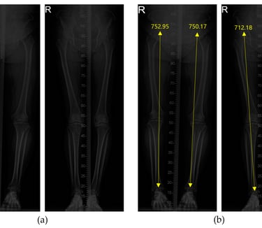 Visual representation of leg length analysis