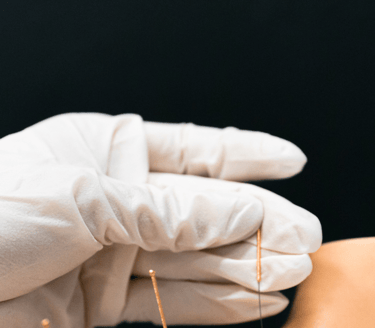 Mobile Dry Needling and Acupuncture in London