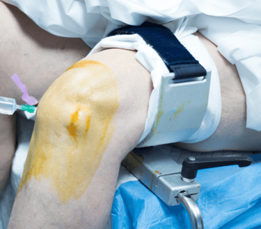 POST SURGERY PHYSIOTHERAPY AT HOME PHYSIO TREATMENT