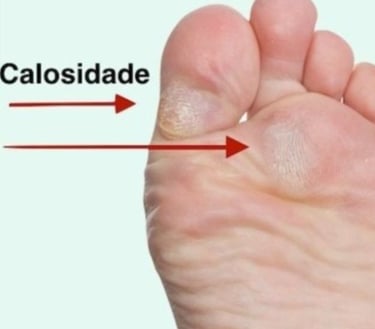 TRATAMENTO CALOS EM BH