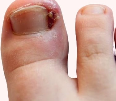 TRATAMENTO UNHA ENCRAVADA EM BH