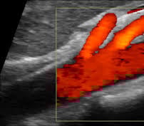 vascular ultrasound mesenteric abdomen pain food weight loss nausea vomiting blood stool ischaemia bowel blockage artery