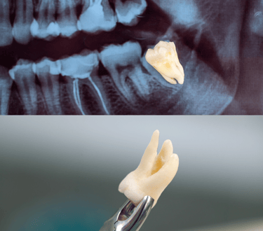 wisdom tooth extraction in Navi Mumbai |  Ekdantam Dental Clinic kopar khairane