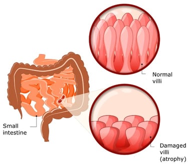 celiac disease