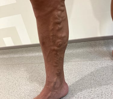 a man with a very large vein on his leg